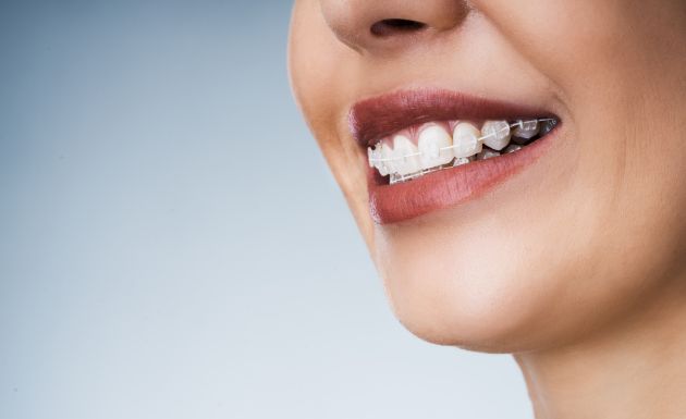 Eastbury Dental Damon Clear