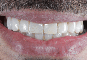 After - Eastbury Dental Practice