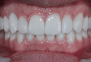 After - Eastbury Dental Practice