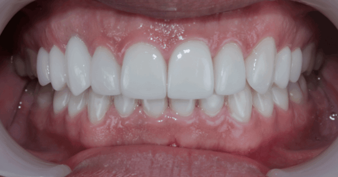 After - Eastbury Dental Practice