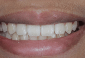 After - Eastbury Dental Practice