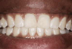 After - Eastbury Dental Practice