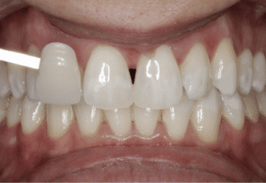 After - Eastbury Dental Practice