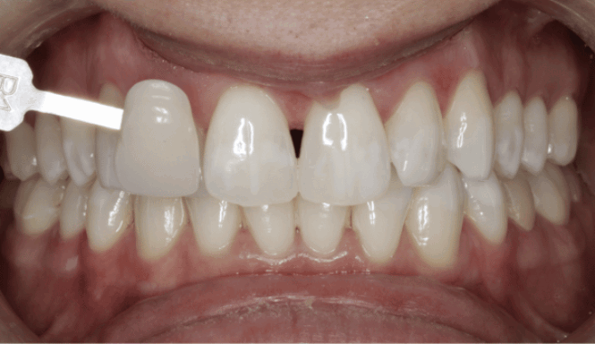 After - Eastbury Dental Practice