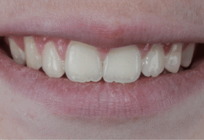 After - Eastbury Dental Practice