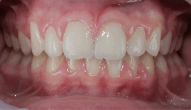 After - Eastbury Dental Practice