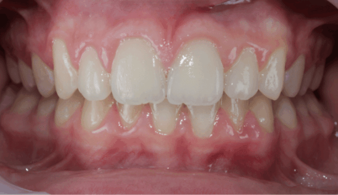 After - Eastbury Dental Practice